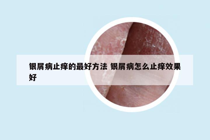 银屑病止痒的最好方法 银屑病怎么止痒效果好