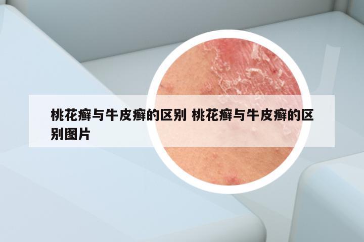 桃花癣与牛皮癣的区别 桃花癣与牛皮癣的区别图片