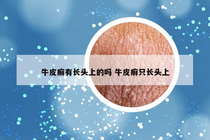 牛皮癣有长头上的吗 牛皮癣只长头上