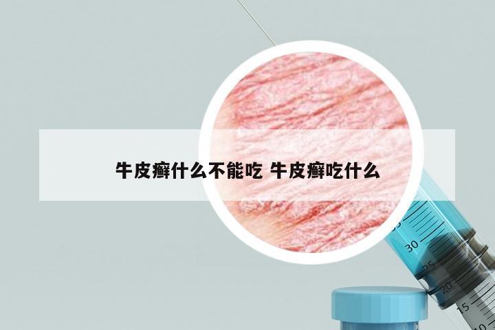 牛皮癣什么不能吃 牛皮癣吃什么