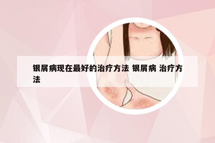 银屑病现在最好的治疗方法 银屑病 治疗方法