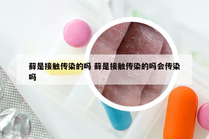 藓是接触传染的吗 藓是接触传染的吗会传染吗