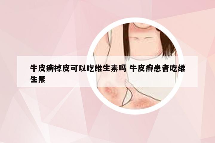 牛皮癣掉皮可以吃维生素吗 牛皮癣患者吃维生素