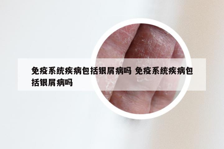 免疫系统疾病包括银屑病吗 免疫系统疾病包括银屑病吗