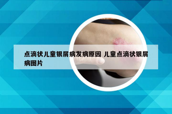 点滴状儿童银屑病发病原因 儿童点滴状银屑病图片