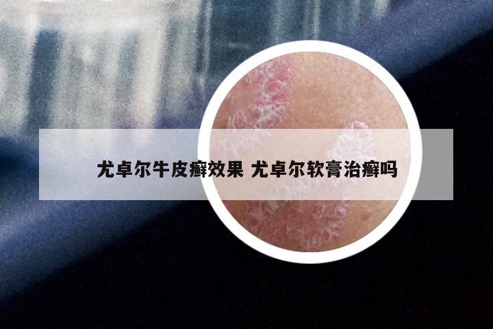 尤卓尔牛皮癣效果 尤卓尔软膏治癣吗