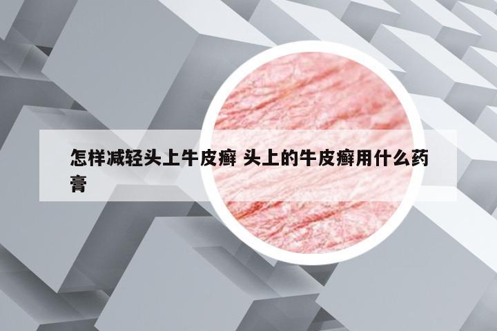 怎样减轻头上牛皮癣 头上的牛皮癣用什么药膏