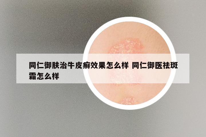 同仁御肤治牛皮癣效果怎么样 同仁御医祛斑霜怎么样
