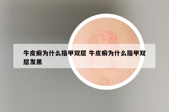 牛皮癣为什么指甲双层 牛皮癣为什么指甲双层发黑