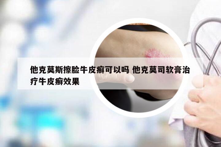 他克莫斯擦脸牛皮癣可以吗 他克莫司软膏治疗牛皮癣效果