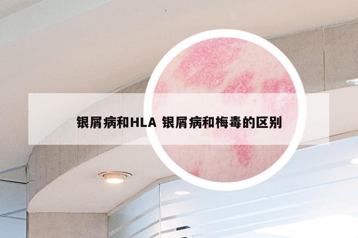 银屑病和HLA 银屑病和梅毒的区别