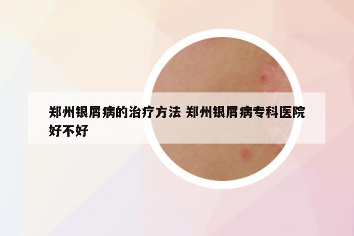 郑州银屑病的治疗方法 郑州银屑病专科医院好不好