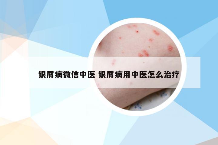 银屑病微信中医 银屑病用中医怎么治疗