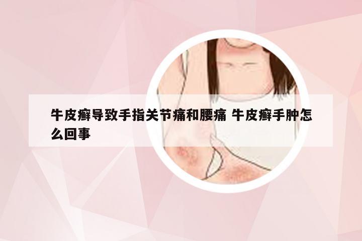 牛皮癣导致手指关节痛和腰痛 牛皮癣手肿怎么回事