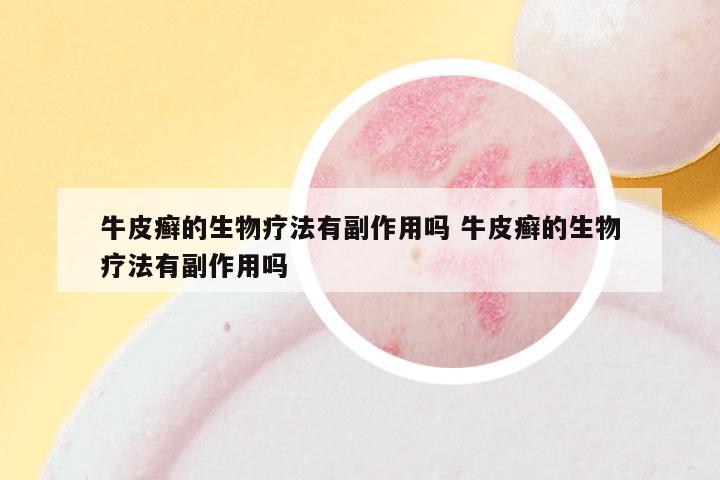 牛皮癣的生物疗法有副作用吗 牛皮癣的生物疗法有副作用吗