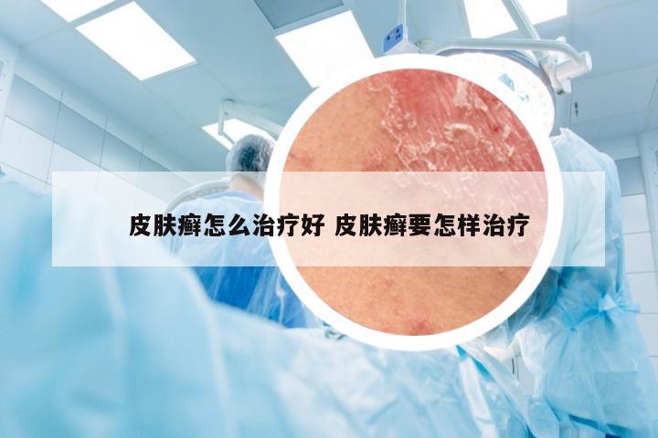 皮肤癣怎么治疗好 皮肤癣要怎样治疗