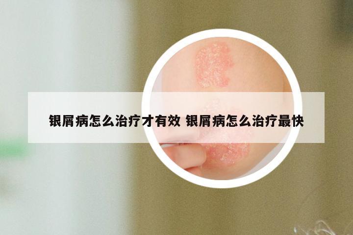 银屑病怎么治疗才有效 银屑病怎么治疗最快