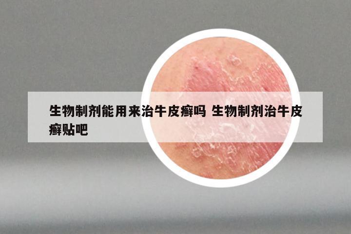 生物制剂能用来治牛皮癣吗 生物制剂治牛皮癣贴吧