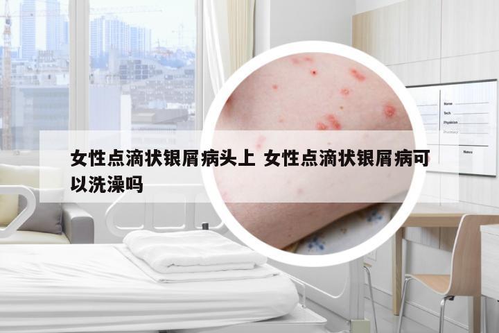 女性点滴状银屑病头上 女性点滴状银屑病可以洗澡吗