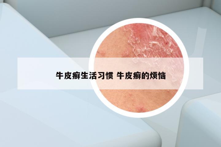 牛皮癣生活习惯 牛皮癣的烦恼