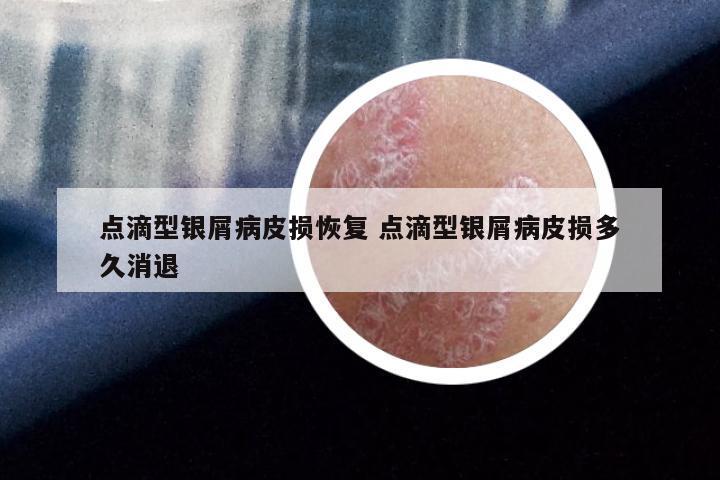 点滴型银屑病皮损恢复 点滴型银屑病皮损多久消退