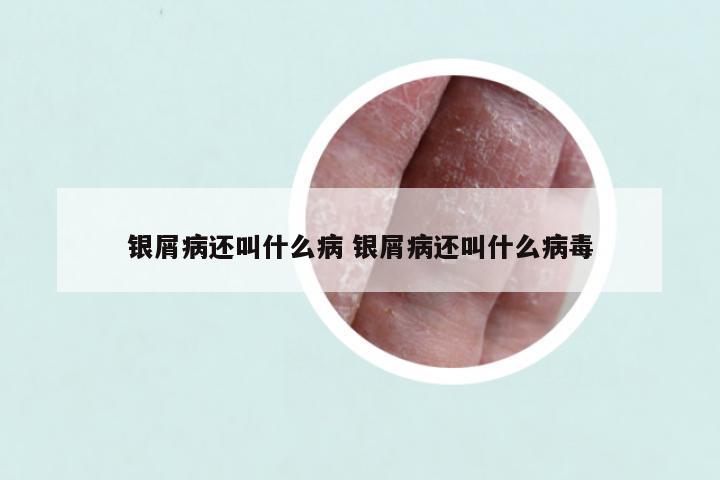 银屑病还叫什么病 银屑病还叫什么病毒