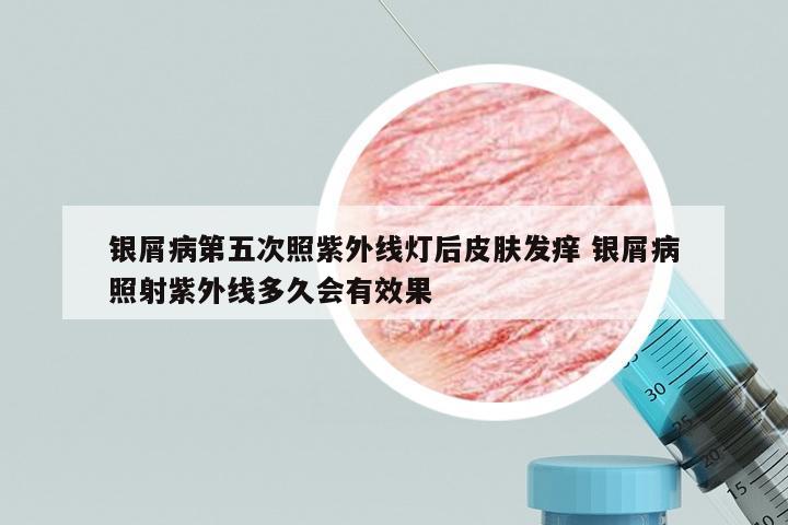 银屑病第五次照紫外线灯后皮肤发痒 银屑病照射紫外线多久会有效果