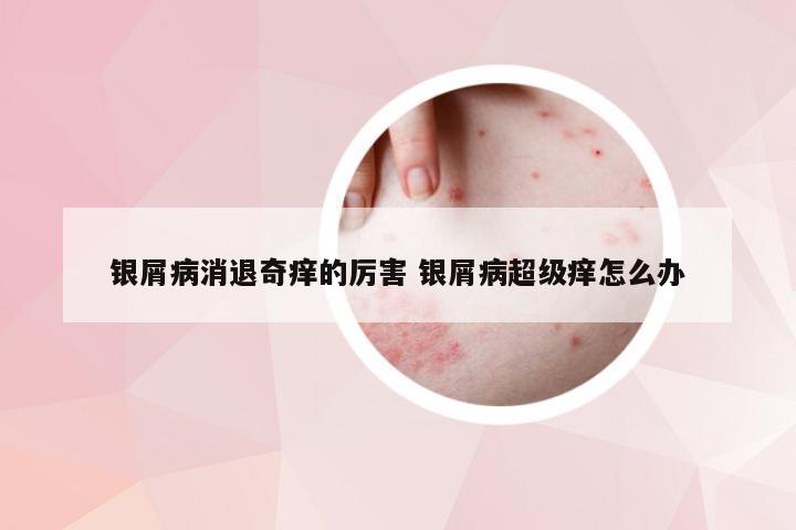 银屑病消退奇痒的厉害 银屑病超级痒怎么办