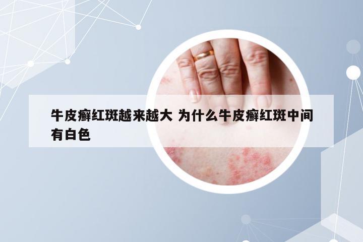 牛皮癣红斑越来越大 为什么牛皮癣红斑中间有白色