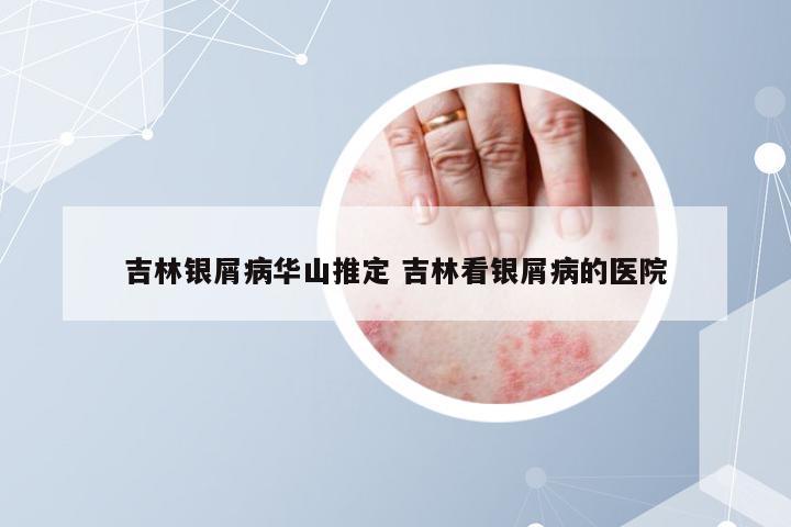 吉林银屑病华山推定 吉林看银屑病的医院