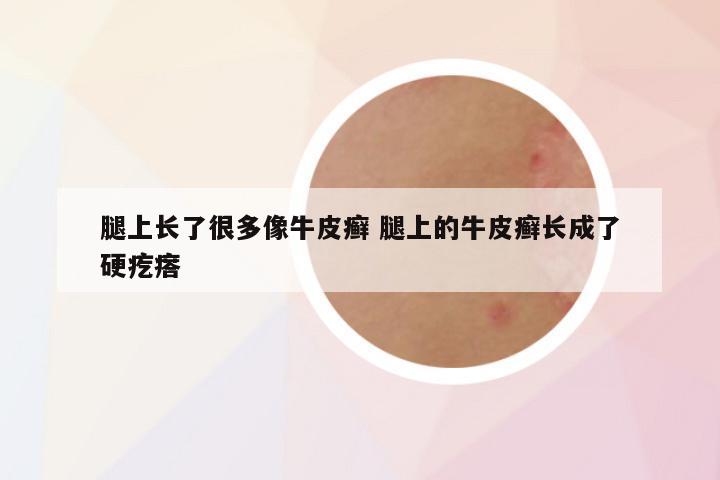 腿上长了很多像牛皮癣 腿上的牛皮癣长成了硬疙瘩