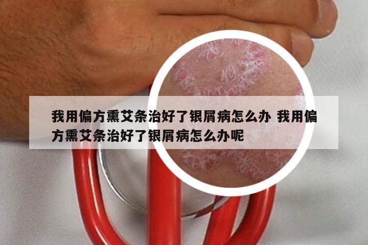 我用偏方熏艾条治好了银屑病怎么办 我用偏方熏艾条治好了银屑病怎么办呢