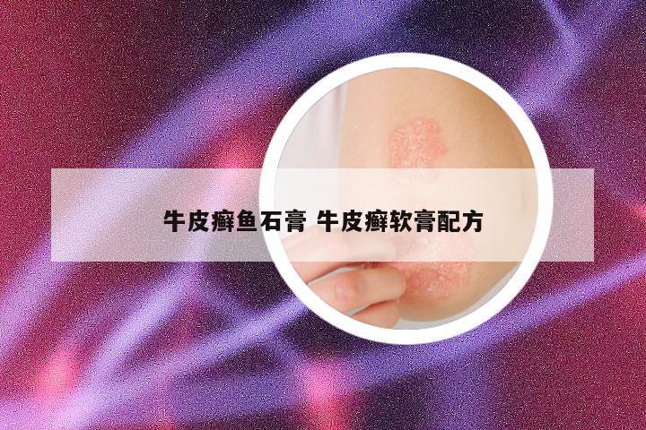 牛皮癣鱼石膏 牛皮癣软膏配方