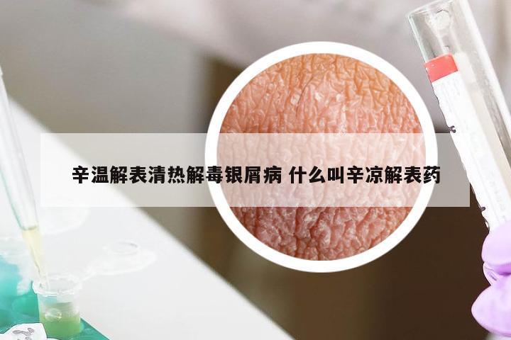 辛温解表清热解毒银屑病 什么叫辛凉解表药