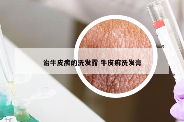 治牛皮癣的洗发露 牛皮癣洗发膏