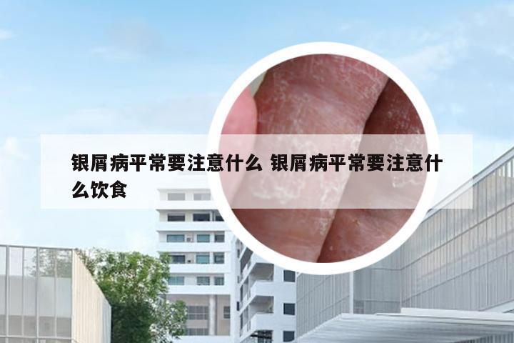 银屑病平常要注意什么 银屑病平常要注意什么饮食