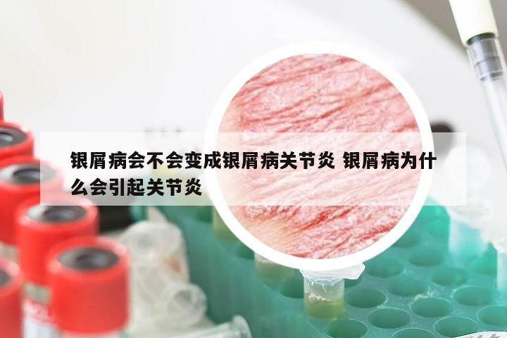 银屑病会不会变成银屑病关节炎 银屑病为什么会引起关节炎