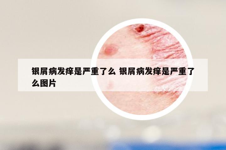 银屑病发痒是严重了么 银屑病发痒是严重了么图片
