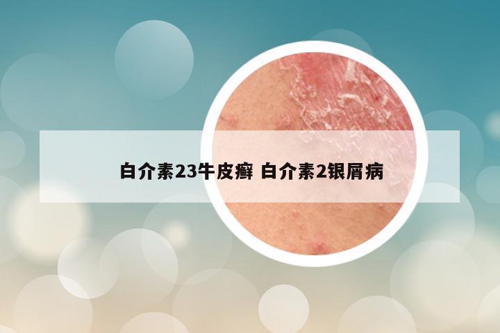 白介素23牛皮癣 白介素2银屑病