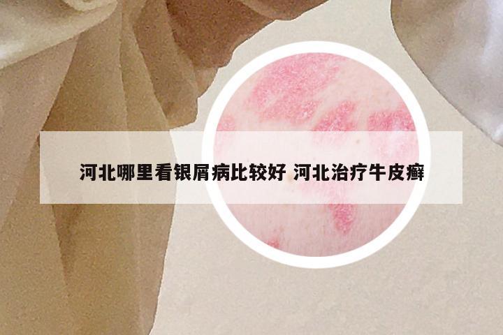河北哪里看银屑病比较好 河北治疗牛皮癣