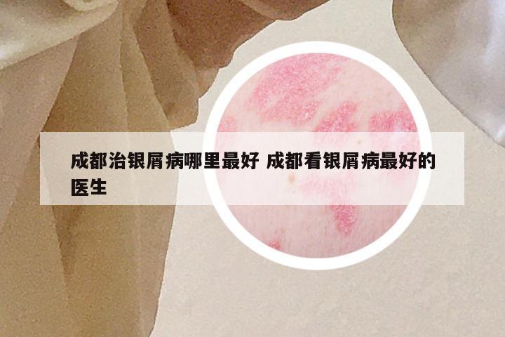 成都治银屑病哪里最好 成都看银屑病最好的医生
