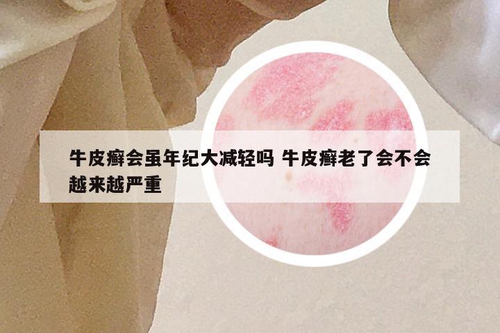 牛皮癣会虽年纪大减轻吗 牛皮癣老了会不会越来越严重