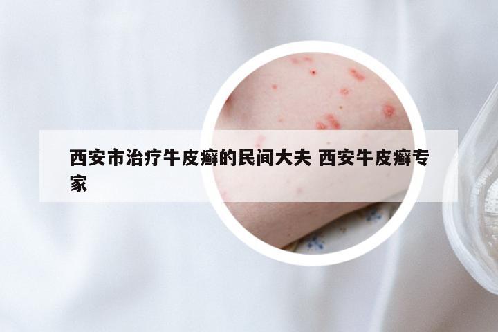 西安市治疗牛皮癣的民间大夫 西安牛皮癣专家