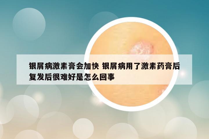 银屑病激素膏会加快 银屑病用了激素药膏后复发后很难好是怎么回事