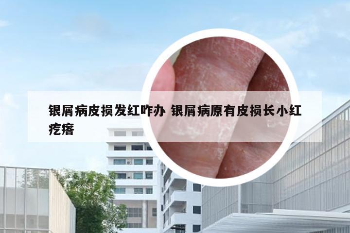 银屑病皮损发红咋办 银屑病原有皮损长小红疙瘩