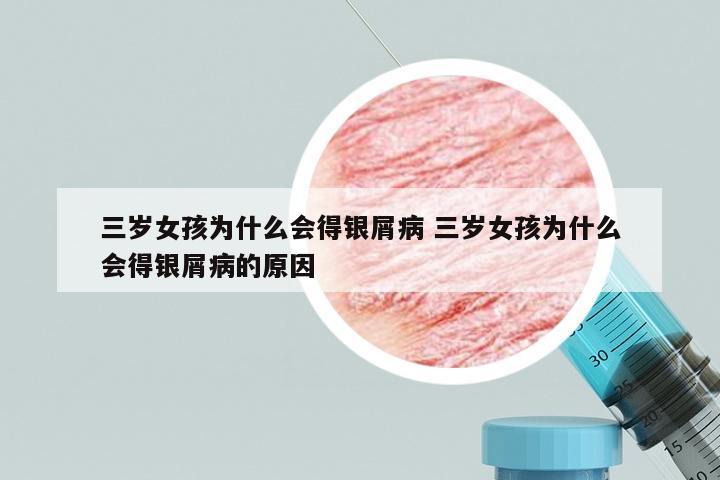 三岁女孩为什么会得银屑病 三岁女孩为什么会得银屑病的原因