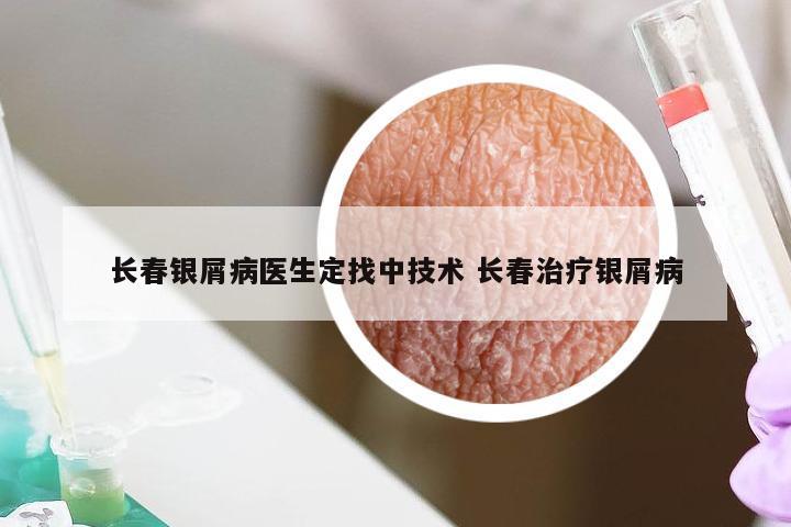 长春银屑病医生定找中技术 长春治疗银屑病