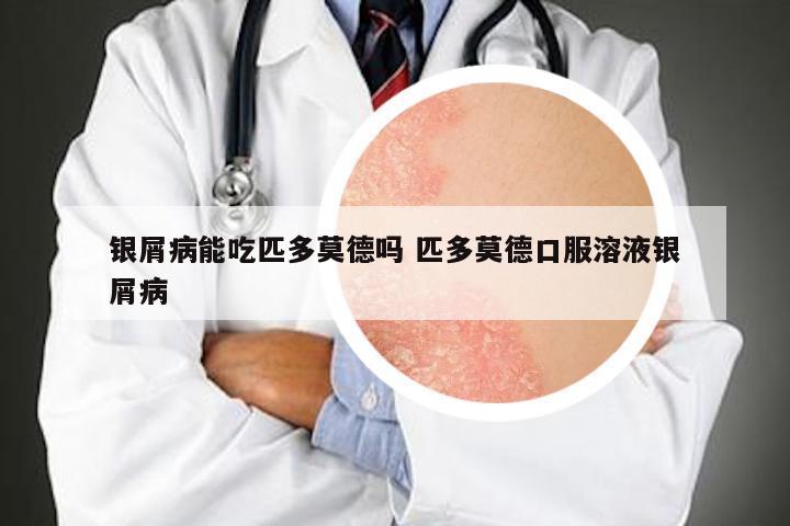银屑病能吃匹多莫德吗 匹多莫德口服溶液银屑病