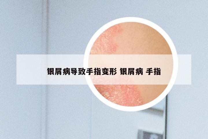 银屑病导致手指变形 银屑病 手指