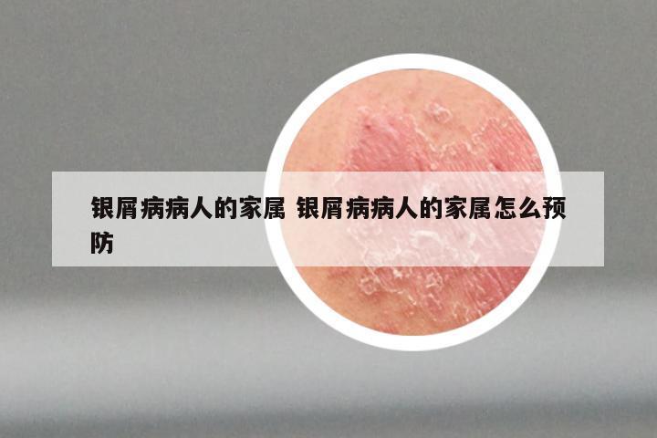 银屑病病人的家属 银屑病病人的家属怎么预防